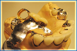 Протез на замках Протез на замках