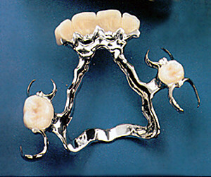 Протез с кламмерами Протез с кламмерами