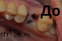 Имплантация зубов Случай №2 фото До