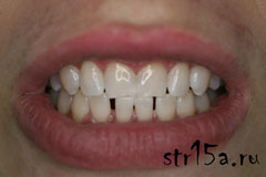 Отбеливание зубов Случай №3 фото После